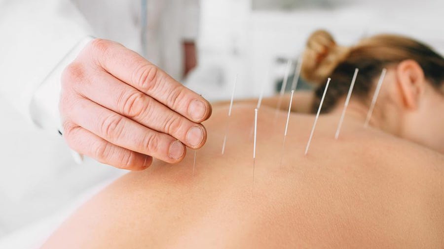 Acupuncture Edmonton | Physical Therapy | Milestone Physio